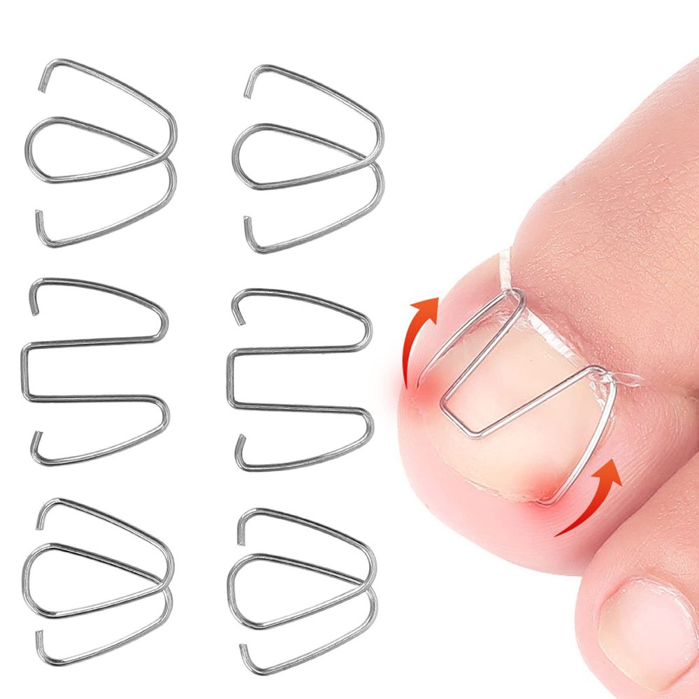 Ingrown Toenail Correction Tool Set