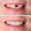 MXRFACTory Instant Denture Veneers, Silica Gel Temporary Dental Prostheses for Upper and Lower Jaw, 2 Pairs view 4