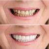 MXRFACTory Temporary Reusable Veneers, Natural Shades, Upper and Lower Teeth, 8 Pairs view 4