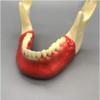 Dental Study Teaching Model, Jaw Implant and Maxillary Sinus Lift Model view 4