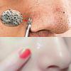 Pimple and Whitehead Extractor Tool Set with Case view 2
