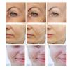 Silk Collagen Lifting Threads for Facial Skin, Trend Skin Solution (A, One Size) view 2