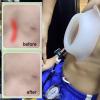 NICHOY Pectus Excavatum Vacuum Bell for Adults and Children (M–M) view 4