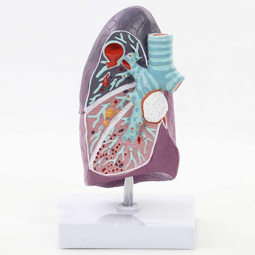 Medical Pathological Human Lung Model, 2/3-Scale Lung Cancer Model for Study
