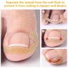 CVNRCLP 17-Piece Ingrown Toenail Treatment Kit view 3