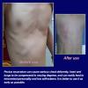 Pectus Excavatum Vacuum Orthosis for Adults and Children (S) view 4