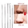 HZWMQDLF Double-Ended Acne Needle and Comedone Extractor Kit, Stainless Steel, 5-Piece, Style C view 2