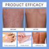 Bee Venom Psoriasis Treatment Spray for All Skin Types view 3
