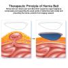 YZWZZXC Men's Inguinal Hernia Truss with 4 Removable Pressure Pads, for Sleep and Pre-/Postoperative Use, S view 3