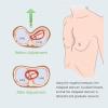 IEOWY Pectus Excavatum Vacuum Bell with Pressure Gauge view 4