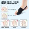 Katyjun Hallux Valgus Corrector, 2 Pairs, Unisex view 3