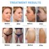 ExoticaBlend 7D HIFU Lifting and Skin-Tightening Device with 5 Attachments view 4